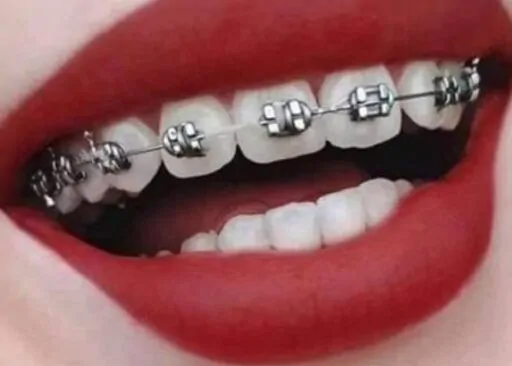 Tooth / Dental Brace – Tagum City