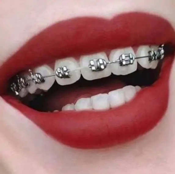 Tooth / Dental Brace – Tagum City